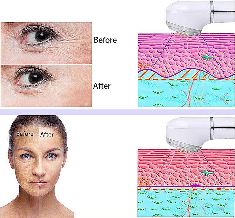 Home Uso RF Rádio Frequência Rejuvenescimento Rejuvenescimento Face Levantamento Apertar Nutriente Infusão de Remoção Remoção Facial Beauty Machine (3)