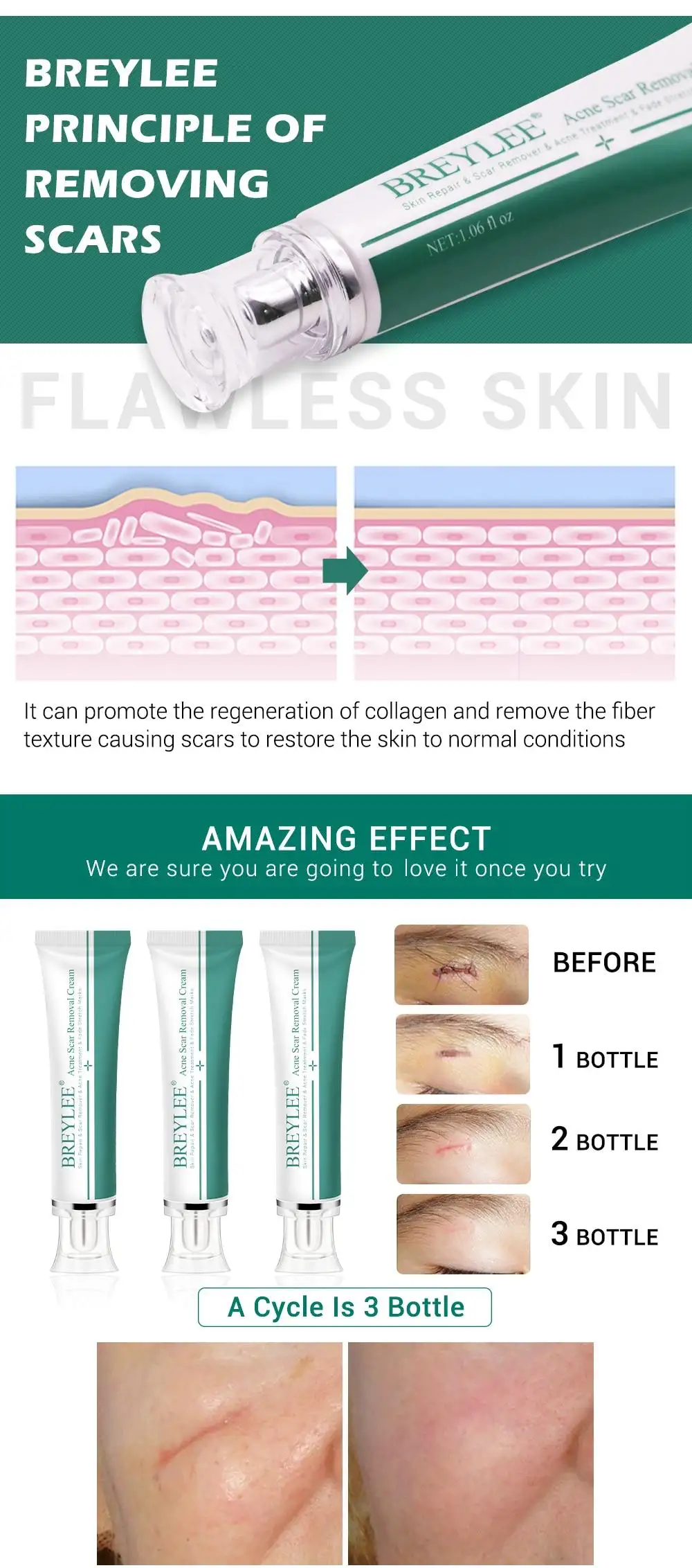 breylee acne scar removal cream