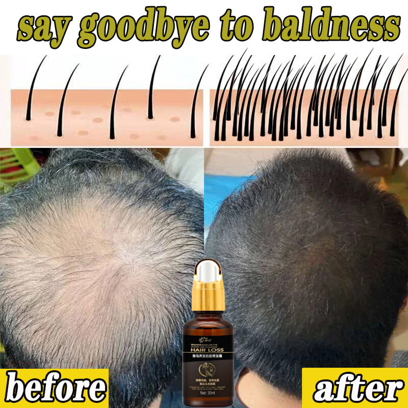 Gambar ??Hair serum Hair tonic for hair growth Serum rambut Herbal Essence Ginger 30ML Fast Promotes Hair Growth Serum Hair Tonic for Hair Growth and Prevents Hair Loss Serum Improve hair follicles Nourishing Hair root Thinning Hair Treatment