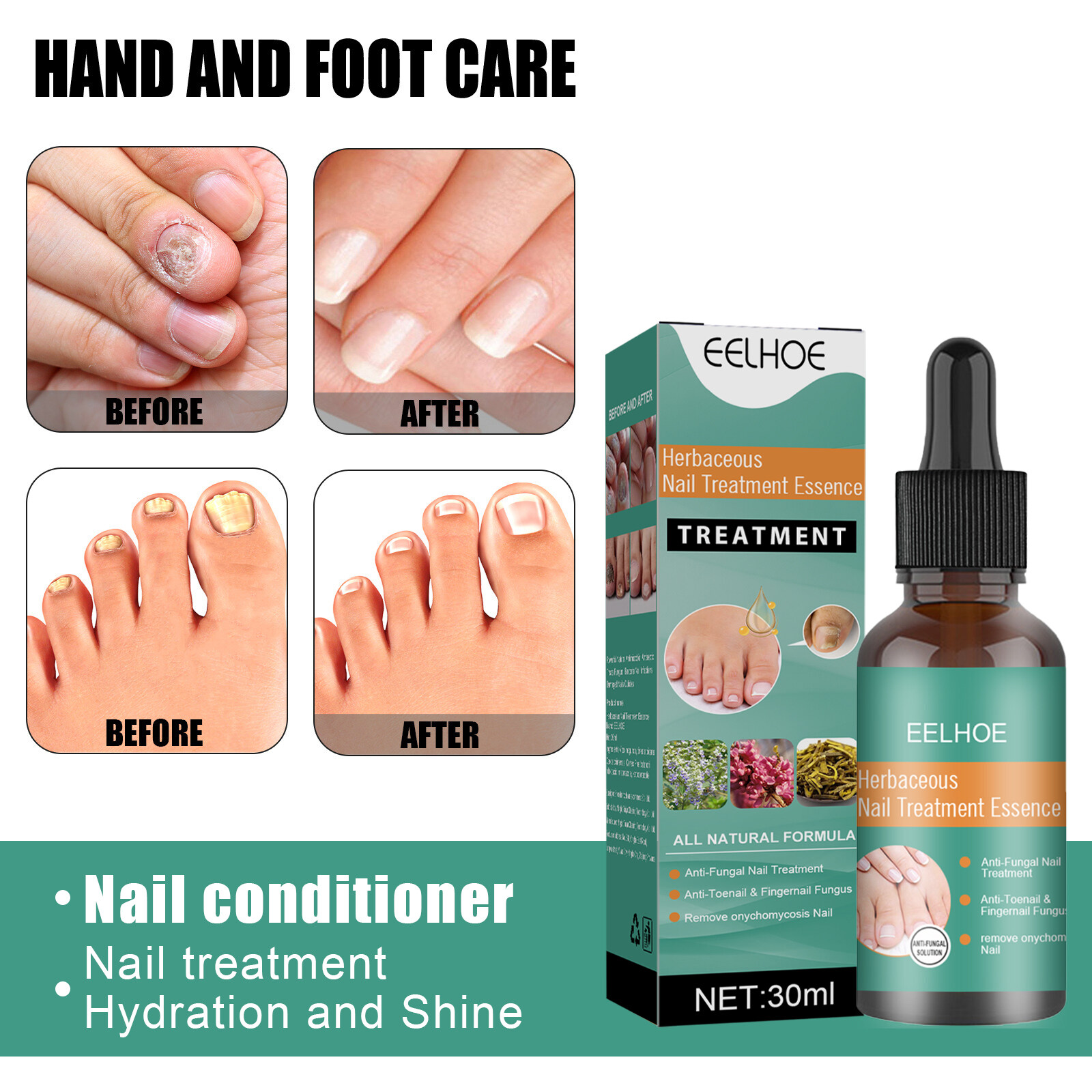 Tea Tree Oil For Nail Fungus: How-to, Does It Work, And Is It Safe | Nail  Fungus Repair Solution Foot Nails Tea Tree Oil Thickened Soft Nails  Nourishing Hand And Foot Nails