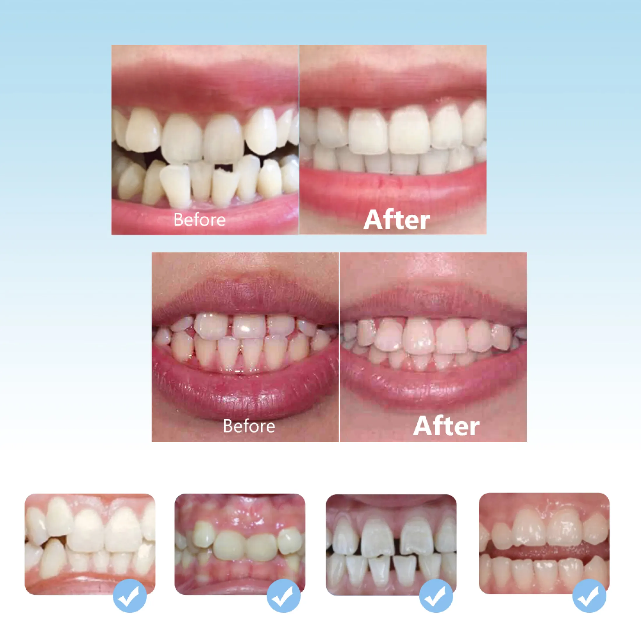 hailicare bộ niềng răng chỉnh nha nha khoa dụng cụ chỉnh răng bằng silicon 3 giai đoạn dụng cụ giữ răng dụng cụ giữ răng dụng cụ chỉnh răng dụng cụ duỗi răng cho trẻ em 8