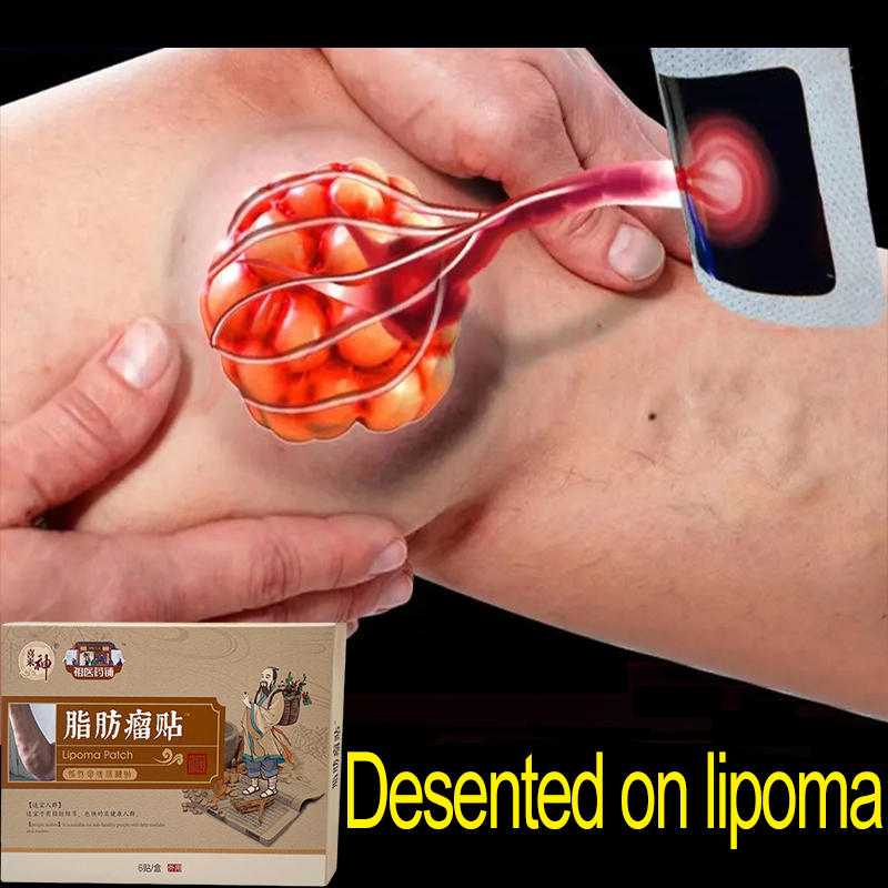 Gambar 99% cure Lipoma Removal Cream Stickers Special Removing Multiple Single Lipoma Subcutaneous Lipoma Lump Bulge ???? 6PCS Box