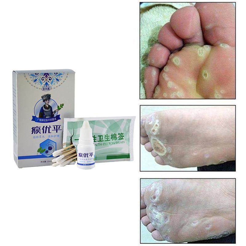 3types Wart Cream Skin Tags Mole Calluses Foot Corn Removal Ointment