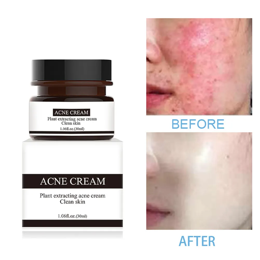 acne marks cream