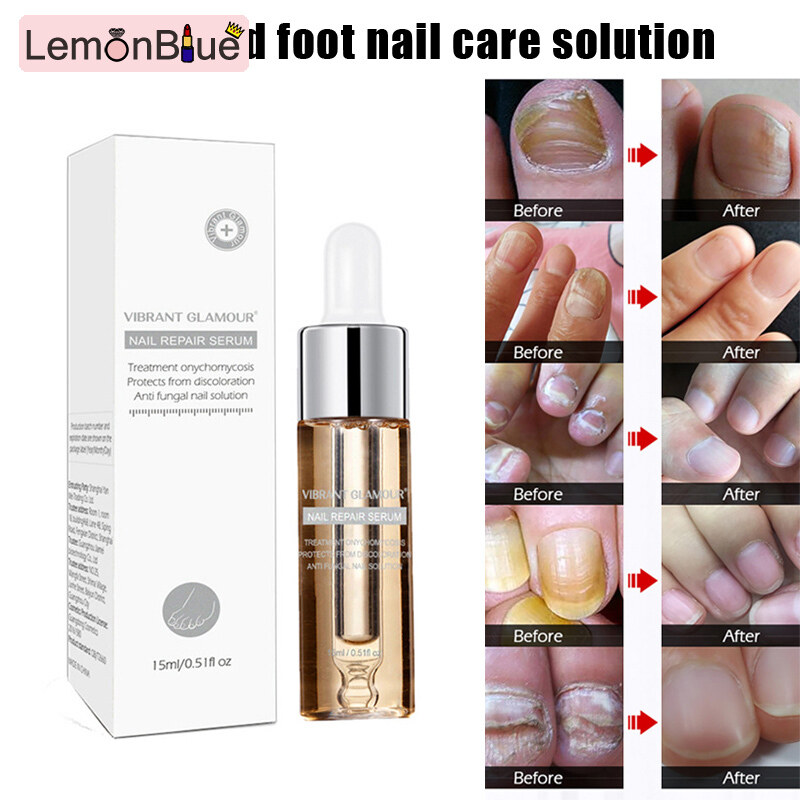 Gambar LemonBlue Hand Foot Onychomycosis Nail Treatment Essence Anti Fungus Nourishing Nail Care