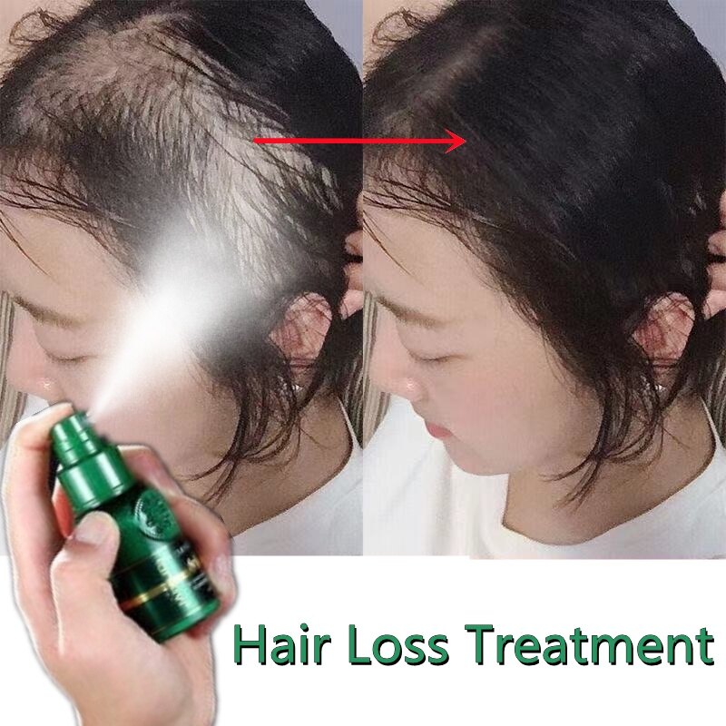 Gambar Hair Growth Serum Hair Growth Spray Hair Loss Serum Enhance Hair Growth Hair Rescue Enhance Hair Growth 30ml