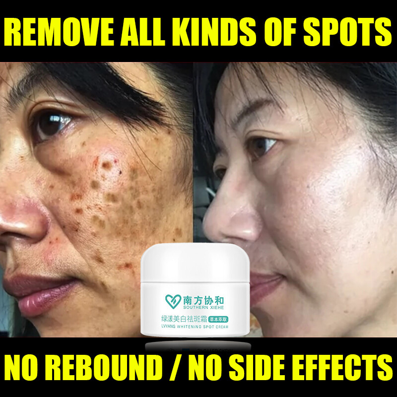 Gambar HANMIAO Freckle removal whitening cream 30g remove pigment dark spots scar moisturizing