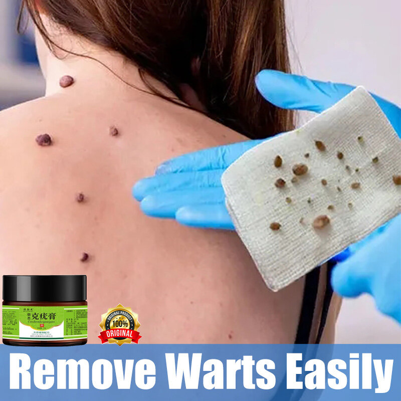 Gambar hard skin wart softener Foot Corn Warts cream 20g Go to the corns get rid of warts to get rid of the calluses Corns Calluses treament in 3 days only 100% orignal The Soles Of The Feet Remove Meat Thorn Warts Skin Tag Antibacterial Solution