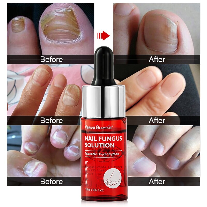 vibrant glamour dưỡng móng tay dài và cứng nail repair serum fungal nail treatment essence remove onychomycosis toe nourishing hand foot nail skin care 15ml 1