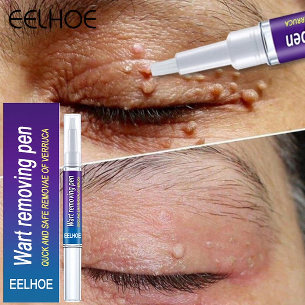 Eelhoe kem loại bỏ mụn cóc loại bỏ mụn cóc loại bỏ da chính hãng loại bỏ mụn cóc phát triển da loại bỏ nốt ruồi và mụn cóc 20g