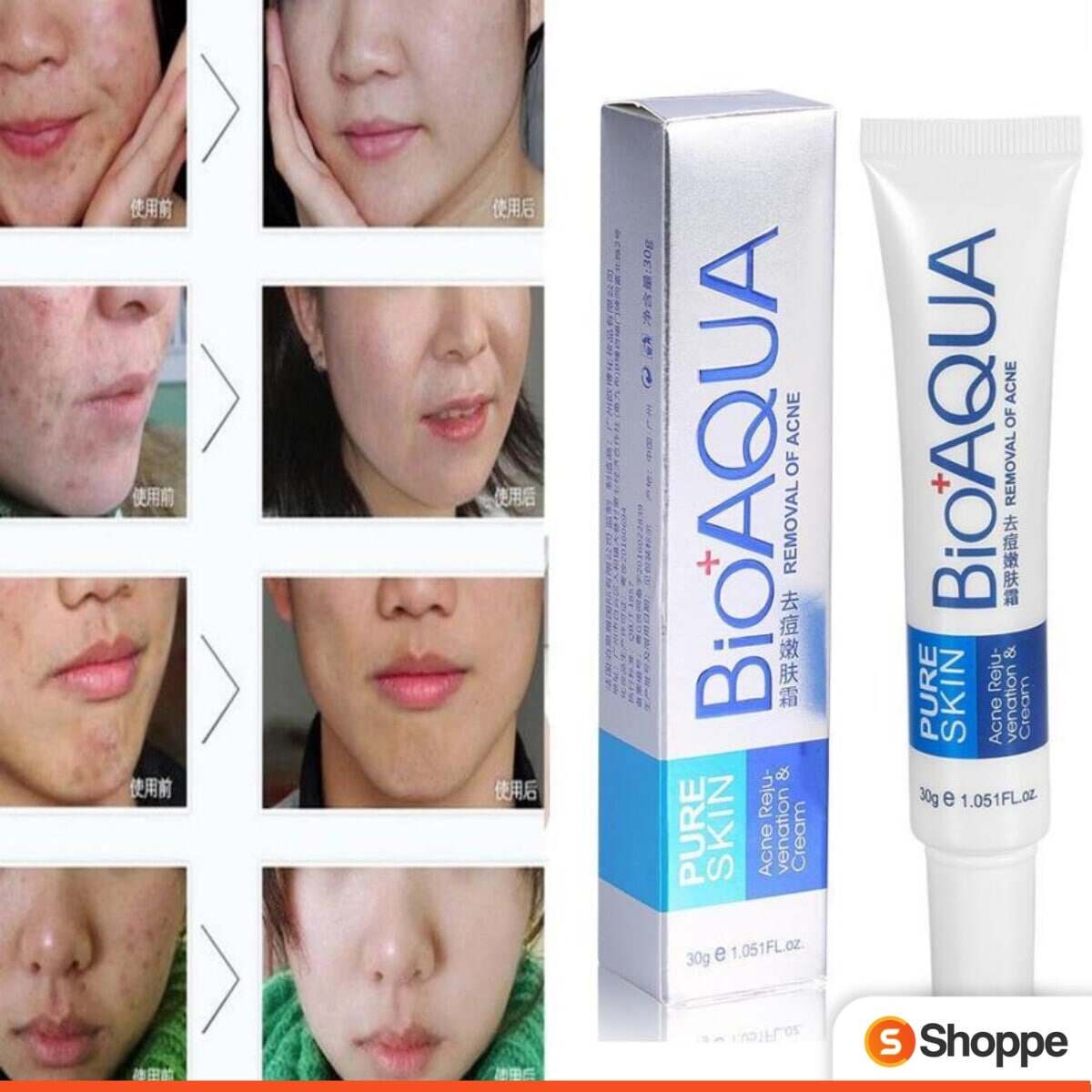 bioaqua removal of acne reviews