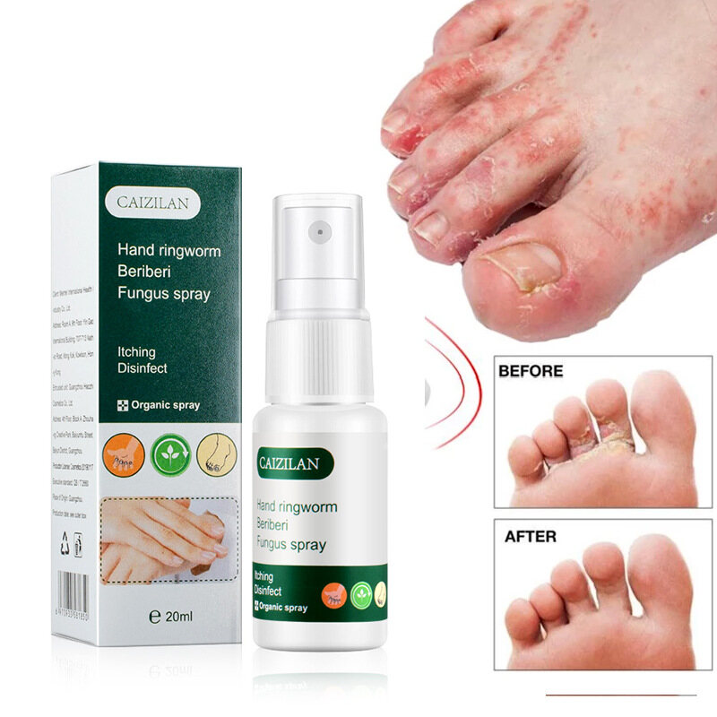 Gambar Hand and foot antibacterial spray 20ml in addition to athlete s foot tinea onychomycosis  Kaki gatal berbau Spray kaki Kulat makan air Foot deodorant spray Fungus Antibacterial Herbal foot spray ??????