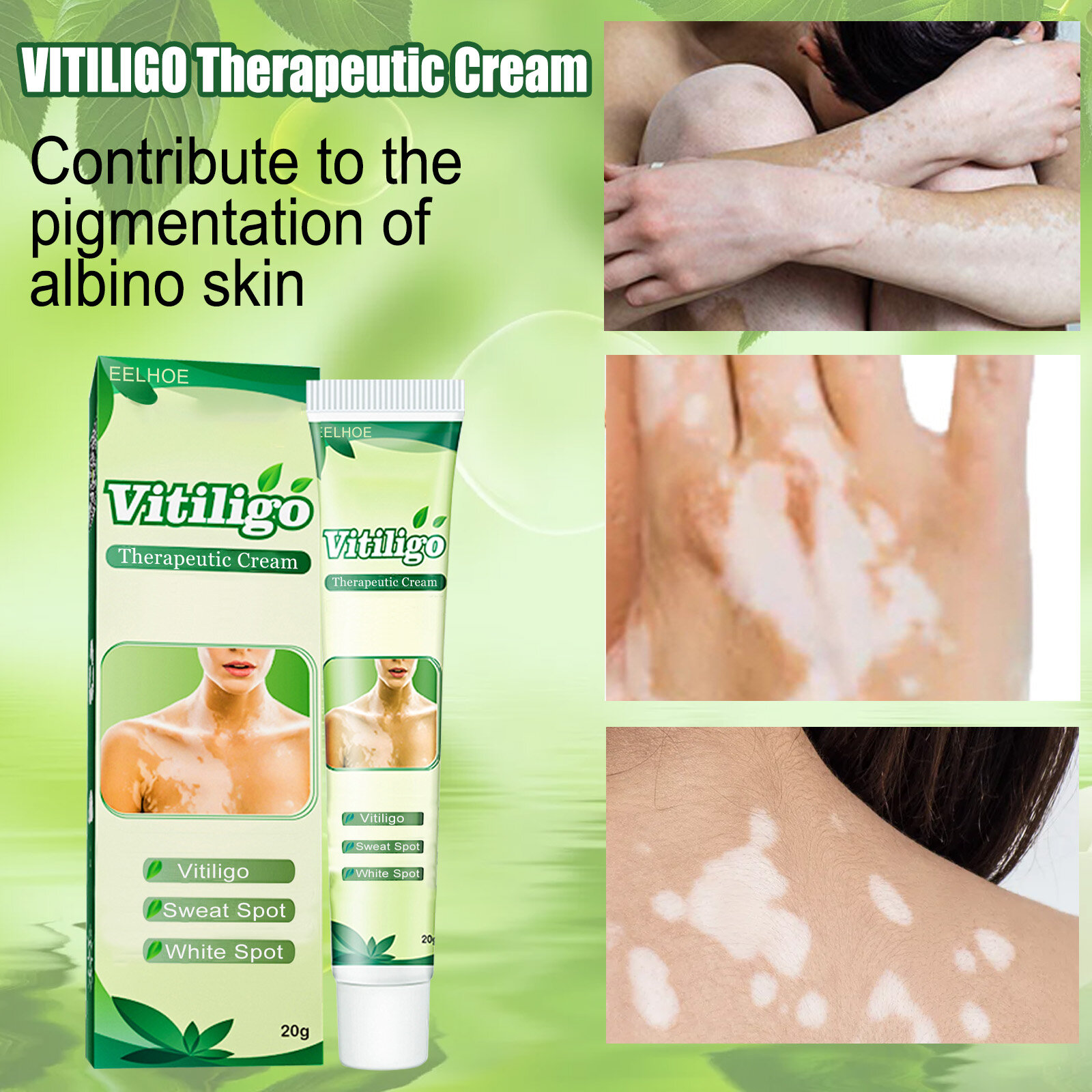 Gambar Eelhoe Vitiligo Therapeutic Cream Portable Safe Vitiligo Treatment Leukoplakia Care Cream Pigmentation Regulating Moisturizers Skin Health Care?20g)??20g?
