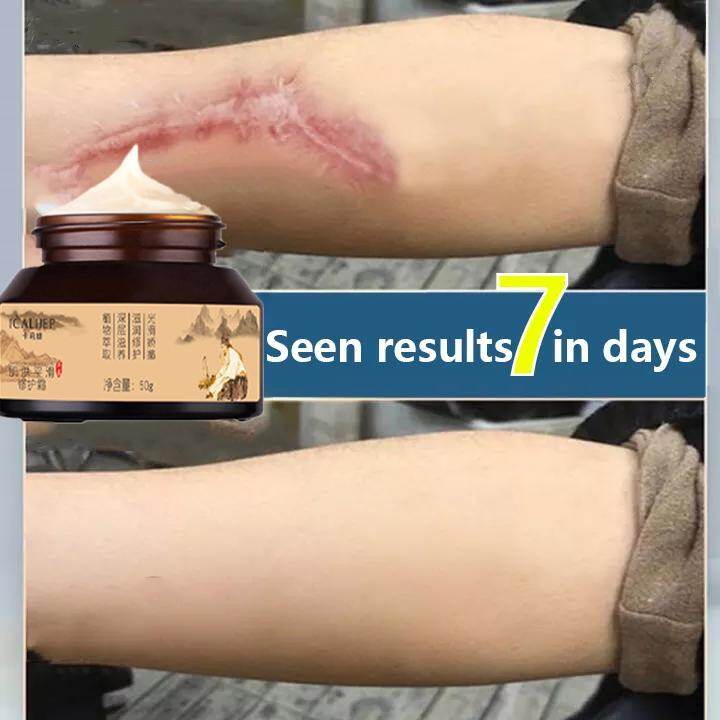 Gambar ?Shipped in Malaysia?Stretch Mark Remover Cream ?Anti Wrinkle Anti Aging Maternity Skin Repair Remove Pregnancy Scars Treatment Body Skin Care 50g