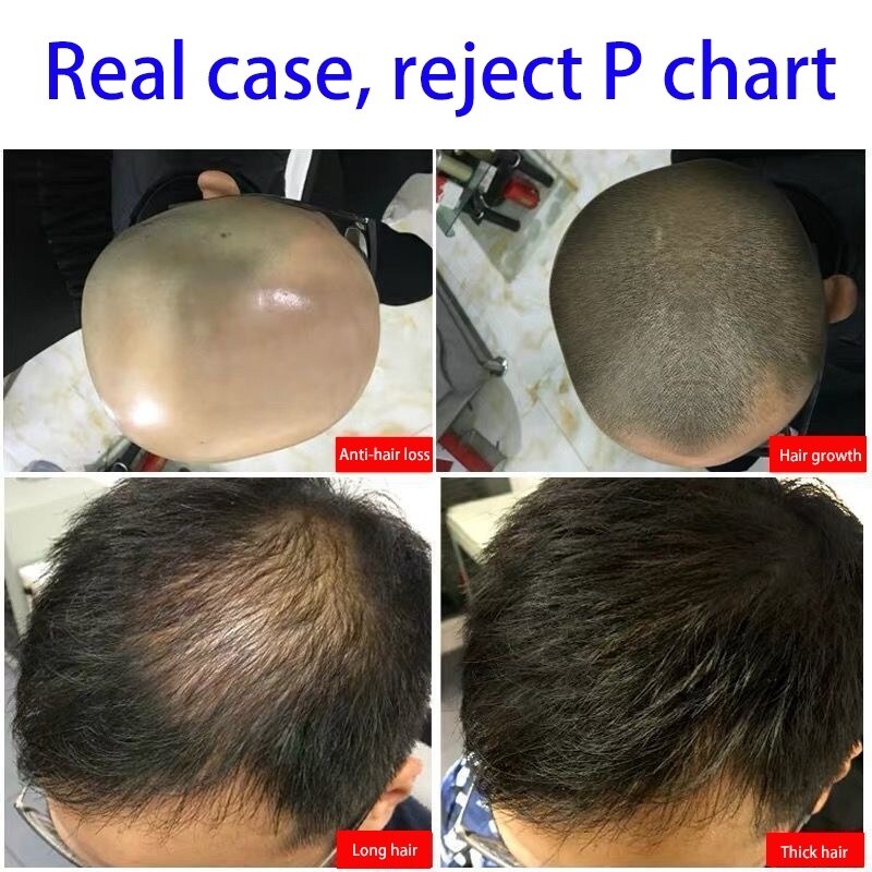 NEW Hair Growth Essence Anti-Hair Loss Fast Hair Growth Nourishes Thinning  Roots Improves Hair Follicle Density | Lazada