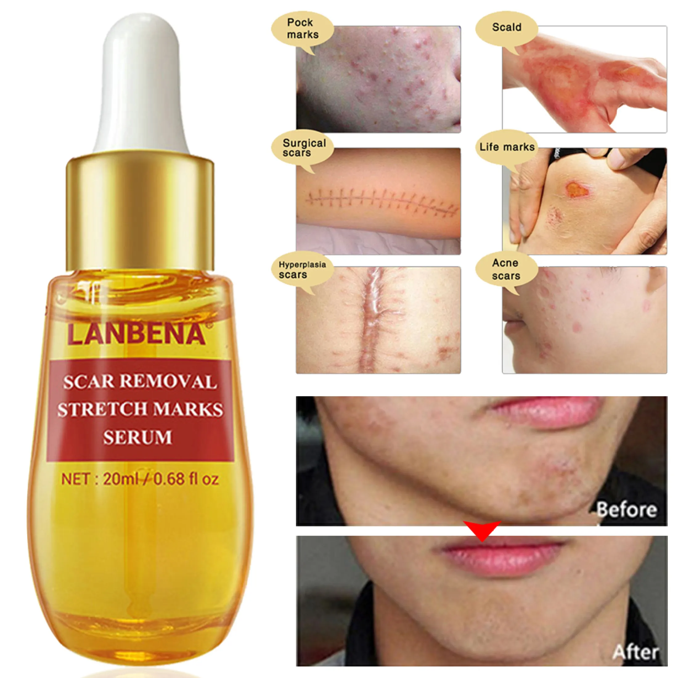 lanbena scar serum