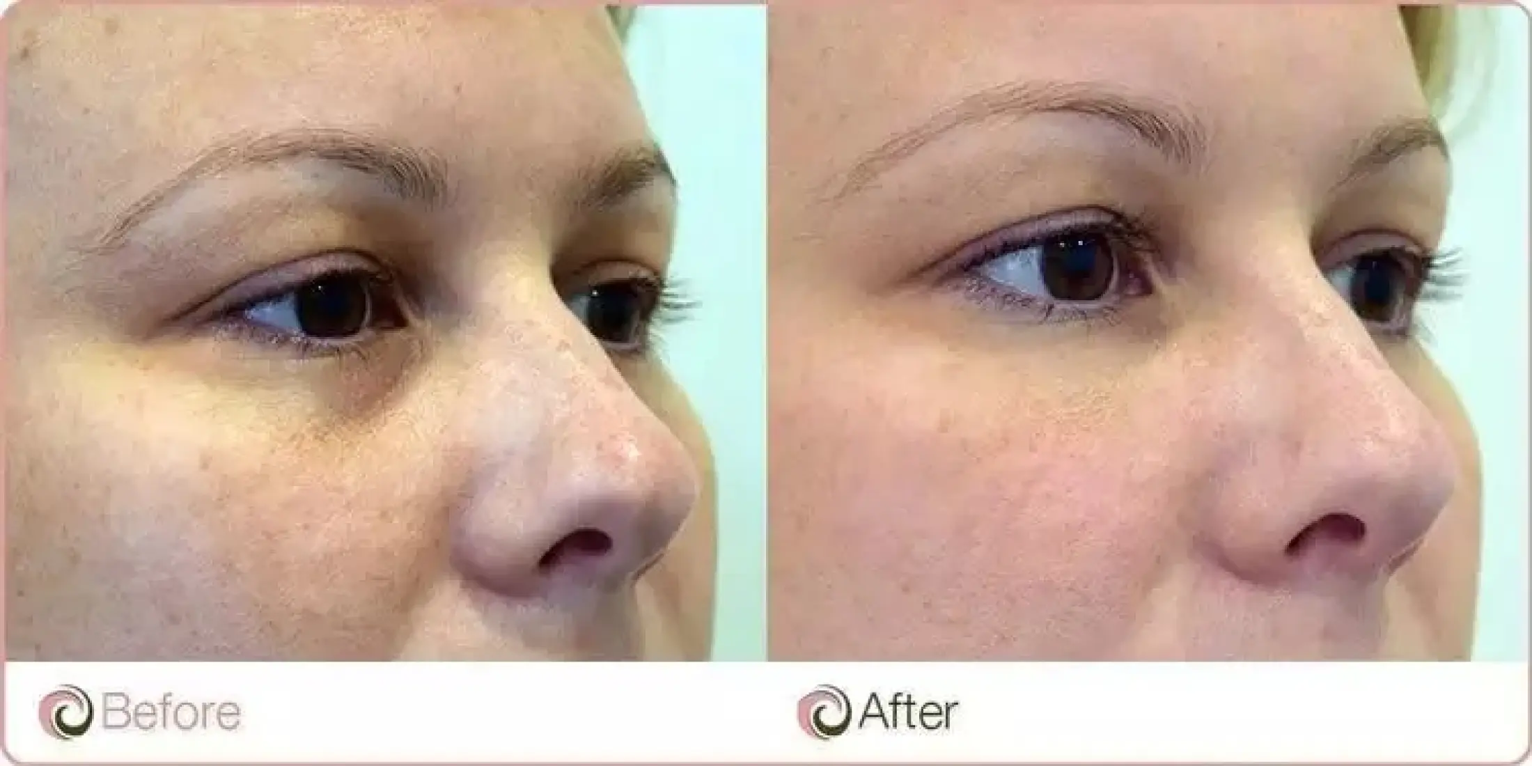 the ordinary retinol eye serum