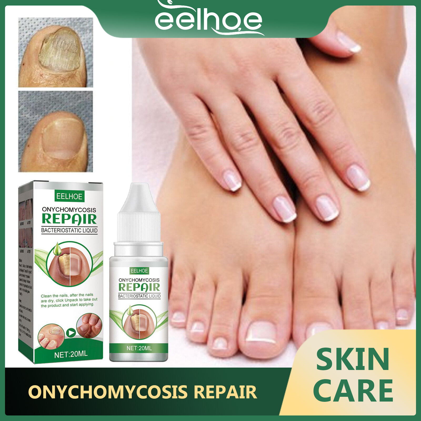 Eelhoe onychomycosis sửa chữa Kìm khuẩn lỏng loại bỏ chăm sóc bàn chân huyết thanh chống nhiễm trùng paronychia onychomycosis nuôi dưỡng làm sáng móng tay (20ml)
