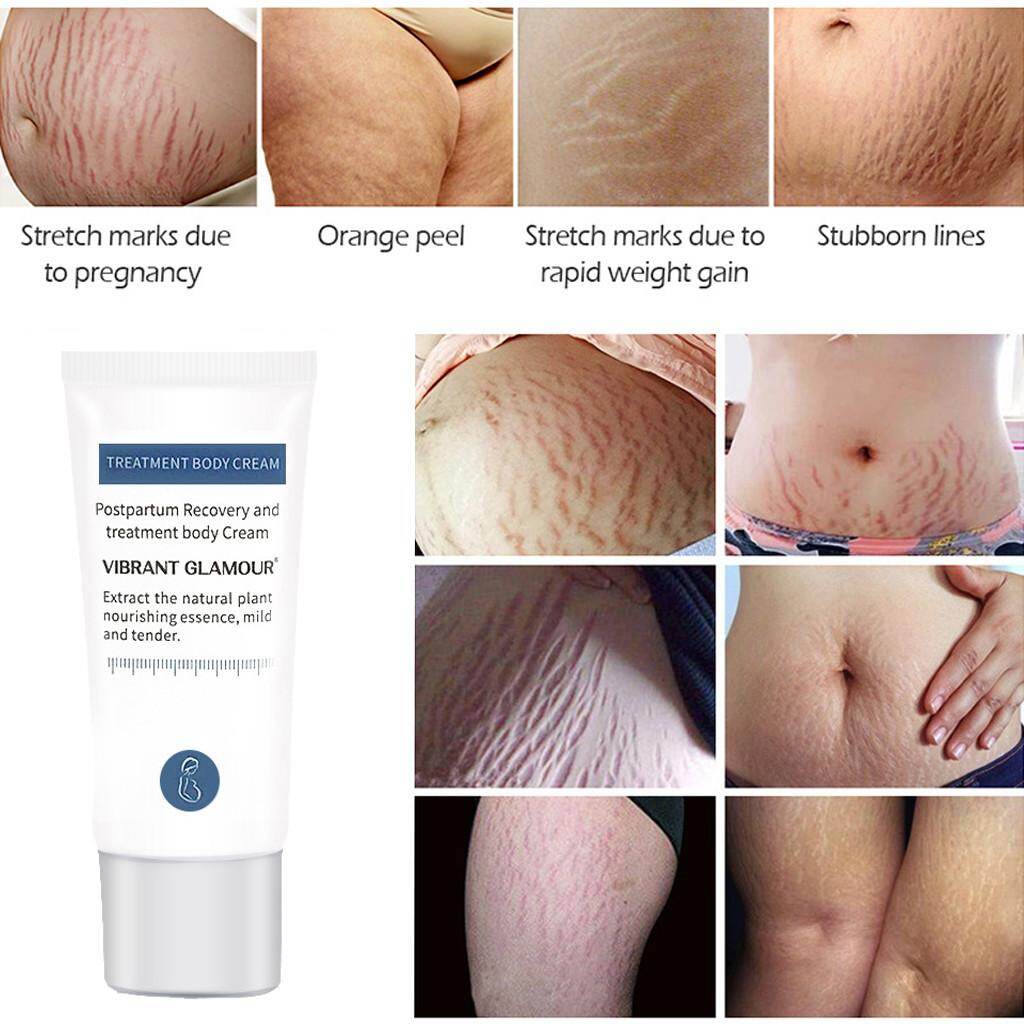 striae gravidarum cream