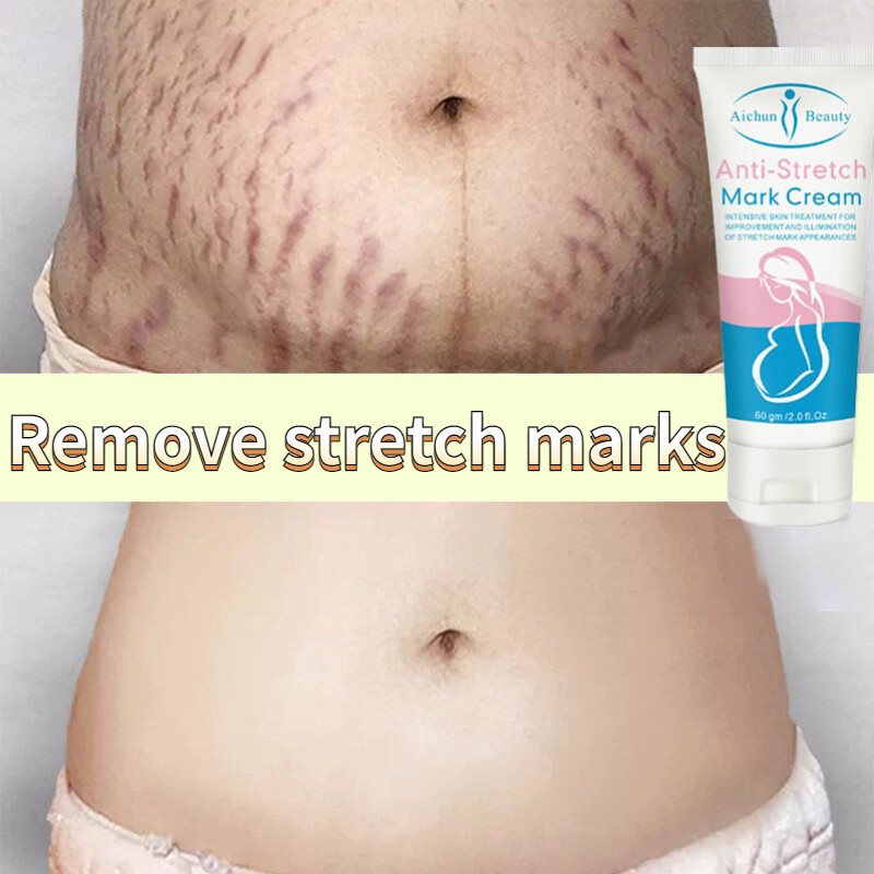 Gambar Stretch mark cream Pregnancy cream Scar remover ubat hilangkan parut serum Stretch mark remover Ubat parut strechmark cream