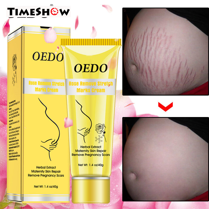 Gambar Stretch Marks Scar Removal Rose Cream Maternity Body Skin Repair Scar Stretch Marks Cream Scar Removal Skin Care Mild Roses Herbal Extract Maternity Skin Repair Stretch Marks Removal Acne Spots Scar Stretch Marks