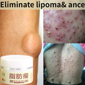 Gambar Lipoma Krim Penyingkiran Menghilangkan Lipomas dan Jerawat dengan Mudah Menghilangkan Lipomas Menghilangkan Fibroid Subcutaneous Ketulan Mengurangkan Kesakitan Berkesan Mengurangkan Keradangan