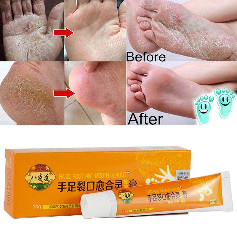 Ttlife Obat Cina Tangan Kaki Pecah Pecah Cream Tumit Pecah Pecah Peeling Kaki Dan Tangan Perbaikan Anti Dry Retak Perawatan Kulit Lazada Indonesia