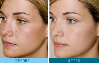 glycolic acid good for acne scars