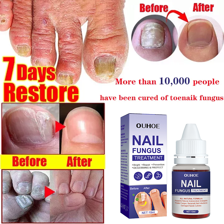 Nailner Fungal Nail Treatment Pen 4 Ml - Extra Kenya - View #2