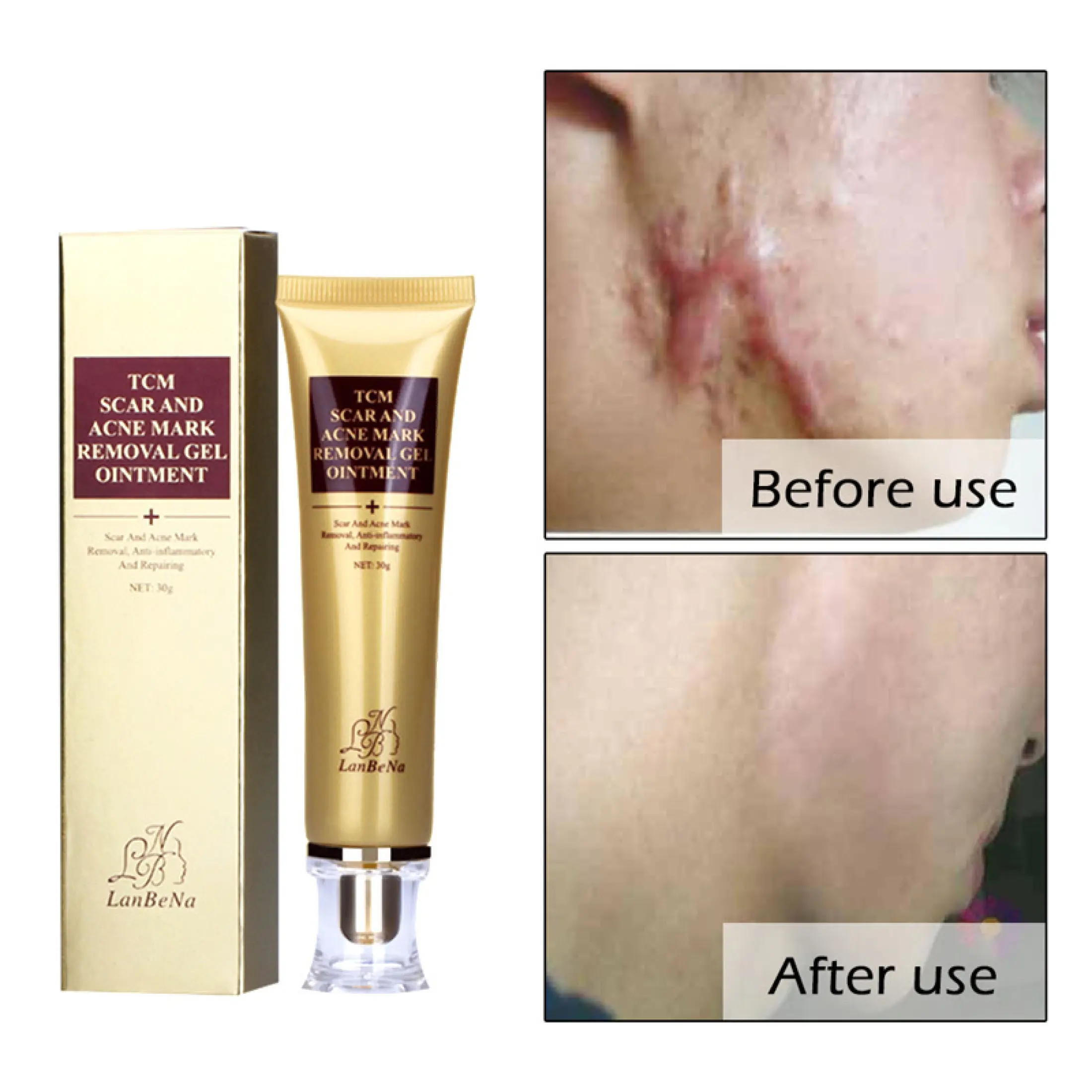 acne marks cream