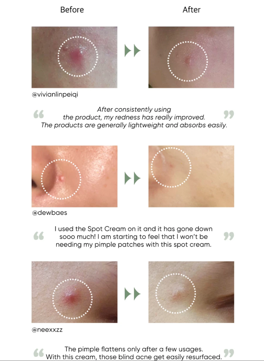 micro needle spot cream