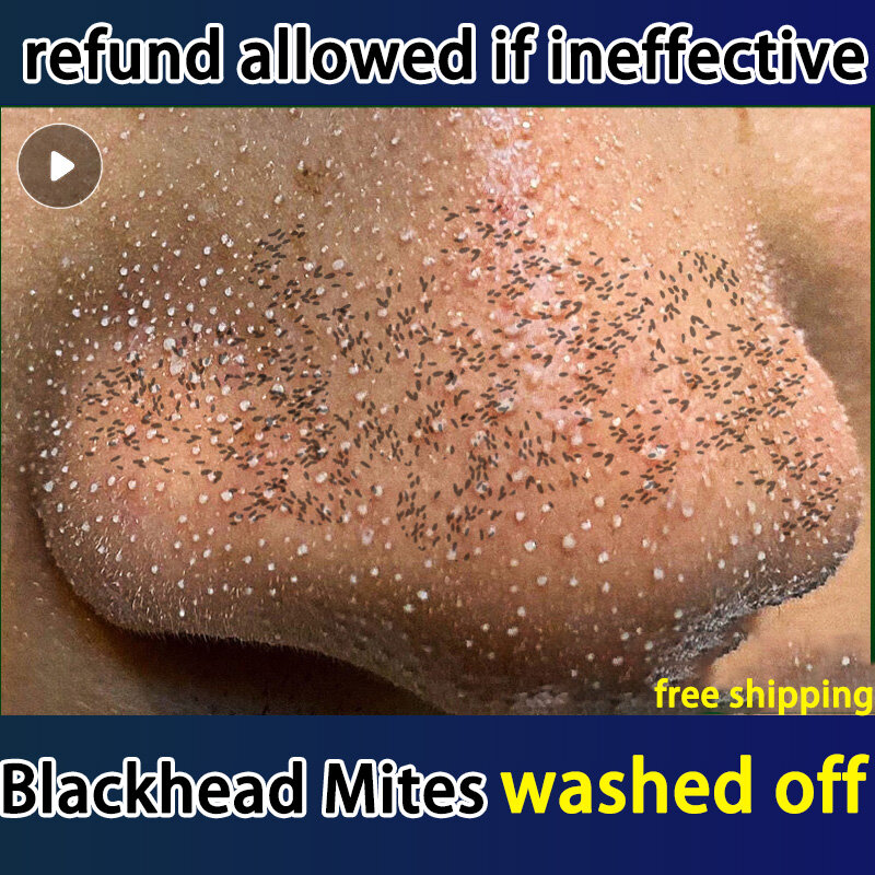 Gambar SUNRANA Acne Removal Blackhead Control Foam Cleanser Anti Sensitive Moisturizing Facial Whitening Cleanser 80g  ???????????