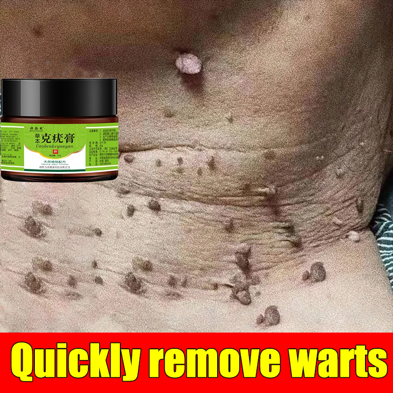 Gambar Warts Skin Tag Cream  Warts cream 20g Wart Remover Ointment Wart Treatment Essence Cream Effectively Remove Foot Corn Plaste Meat Thorn Warts  Calluses Common Warts Flat Warts Sharp Warts Antibacterial