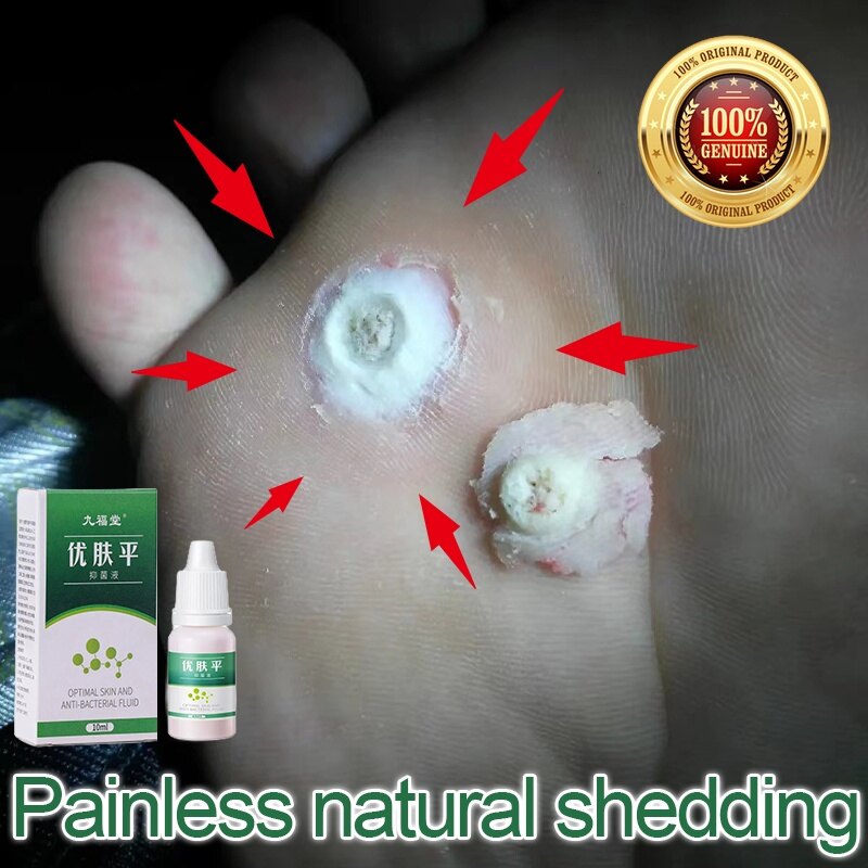 Gambar ubat buang ketuat kaki Wart Remover Cream Tag Solution Skin Tag Mole Buang Tahi Lalat Ketuat Kutil Skin Tag Wart Removal Traditional Natural Mole Ubat buang kutil ketuat tahi lalat biji kolestrol Traditional Mole Removal Pembuang Tahi Lalat Semulajadi