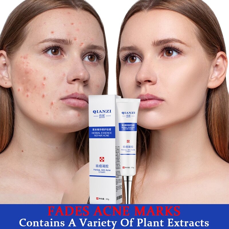 Gambar [Genuine Qianzi] Herbal Essence Acne Gel to remove acne acne marks without leaving marks and deep repair