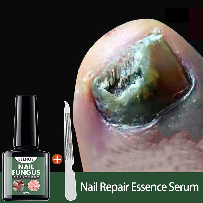 Efero serum nấm móng huyết thanh chống nấm móng loại bỏ nấm móng chăm sóc da tay và chân dưỡng ẩm và sáng bóng thêm 15ml
