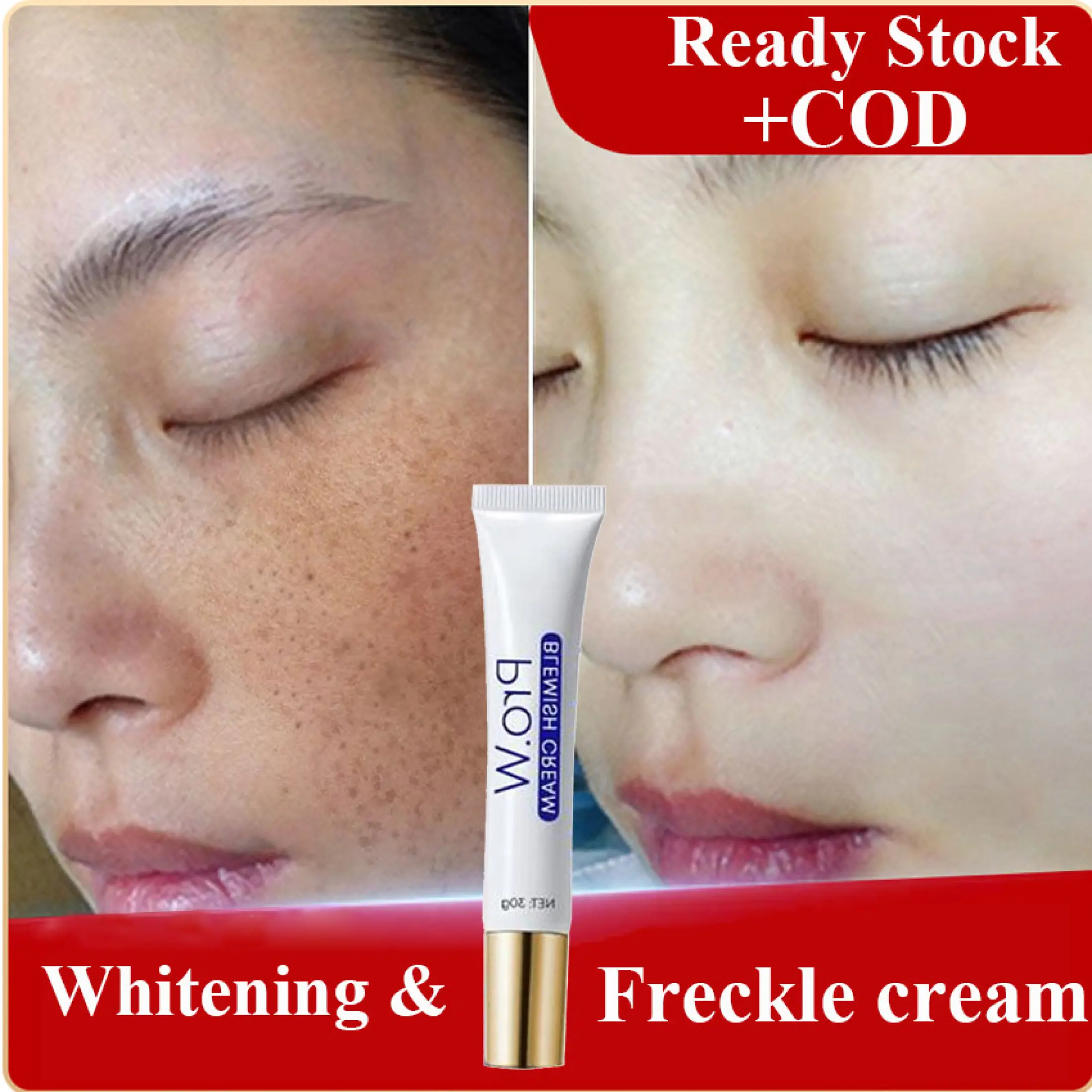 acne removing cream