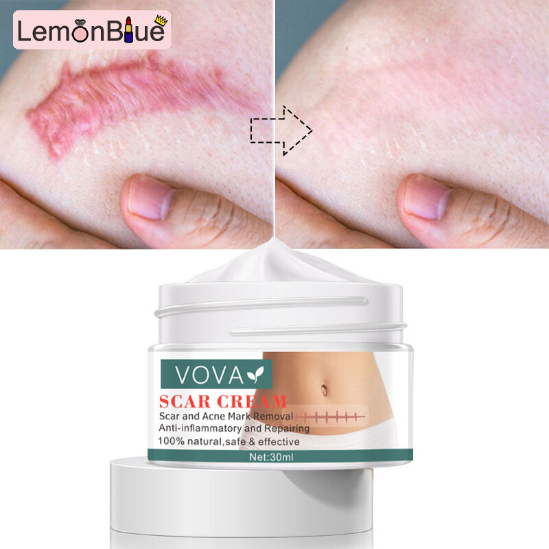 Gambar LemonBlue Scar Removal Cream 30ml Fade Stretch Marks Shrink Pores Gel Treatment Body Face 30ml Fade Stretch Marks Shrink Pores Gel Treatment Body Face Smoothing Cream Scar Removal Cream