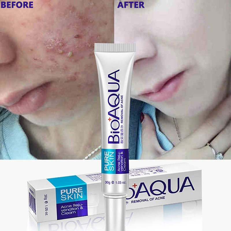 cream bioaqua acne