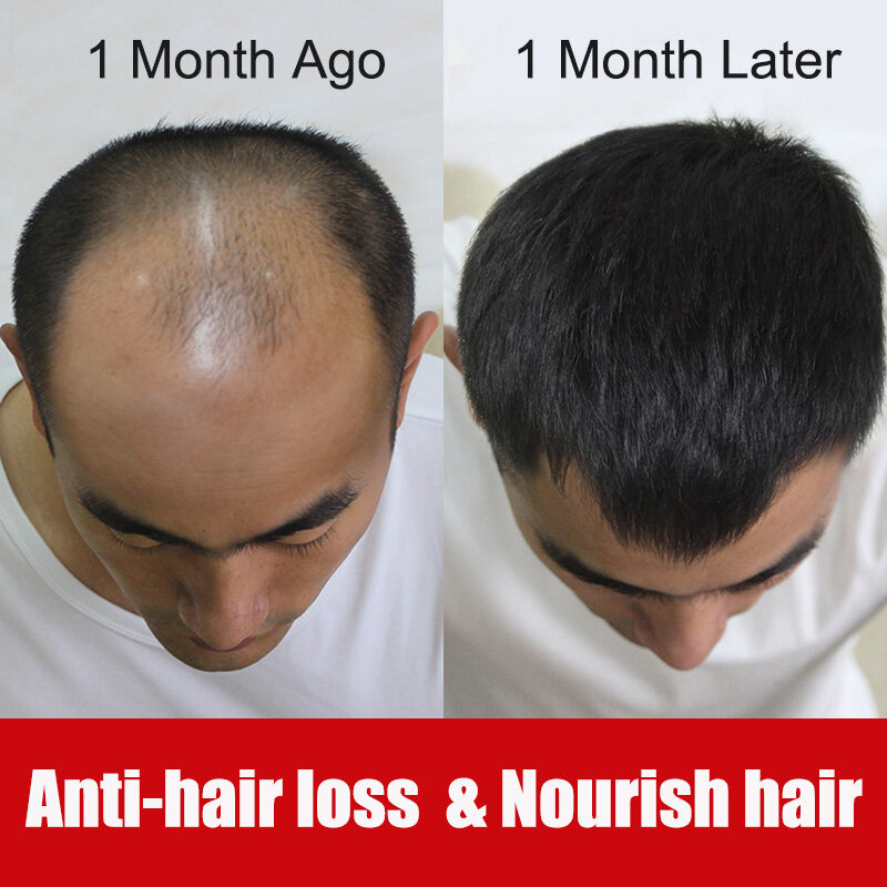 Bbala New Hair Growth Spray Fast Grow Hair Ginger hair lossTreatment  Preventing Hair Loss 30ml | Lazada PH