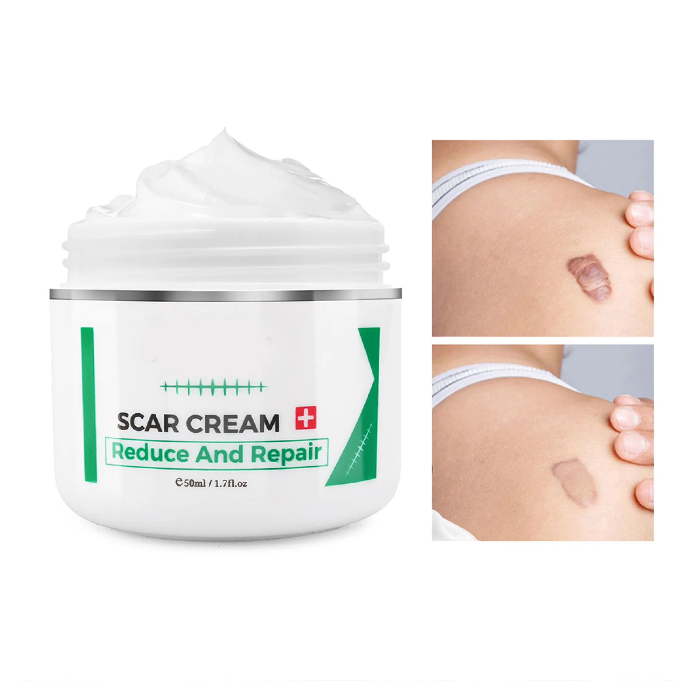 stretch mark lightening cream
