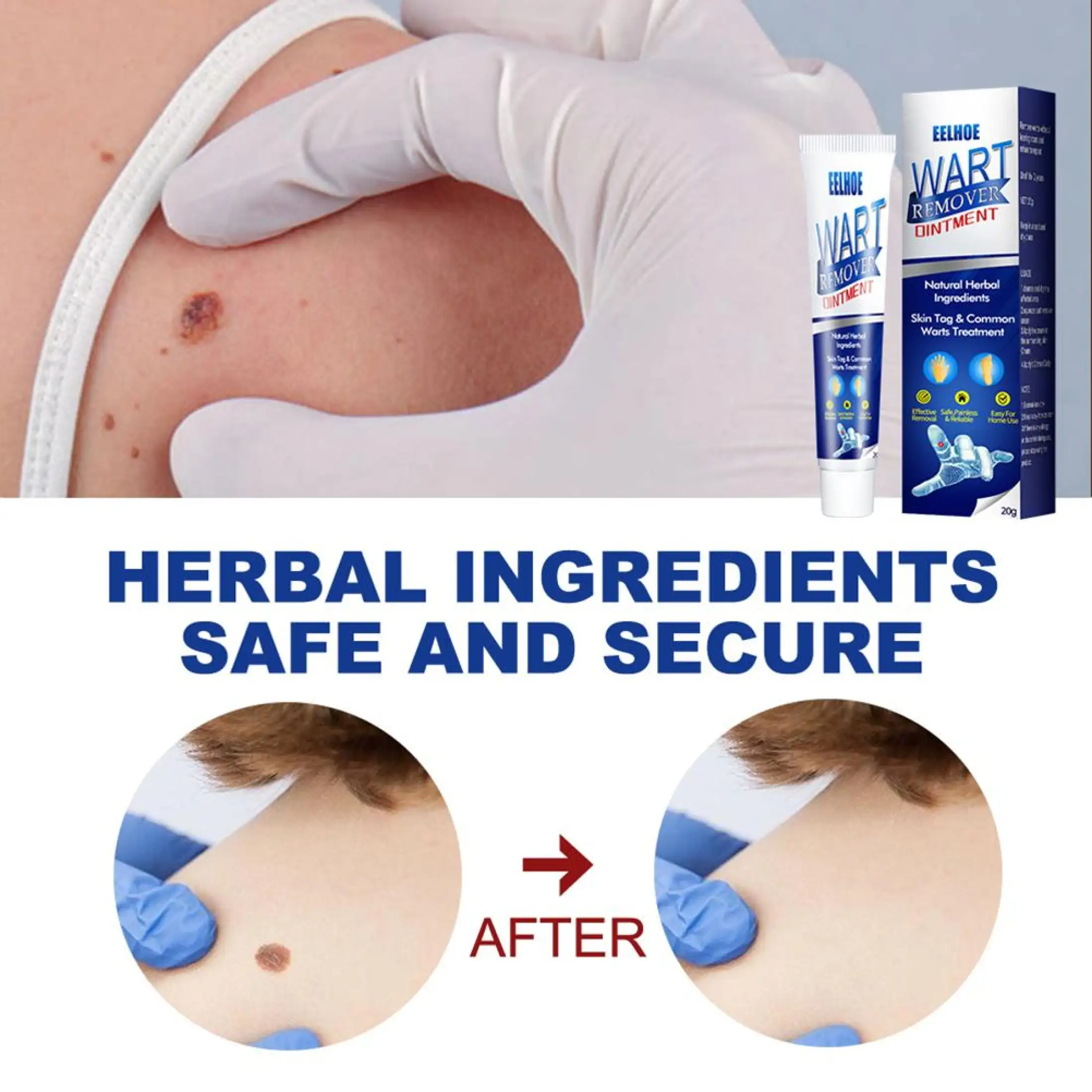 Skin Remover Wart Remover Oitment Easy To Carry For All Skin Efficient Mole Removal Cream Lazada Singapore