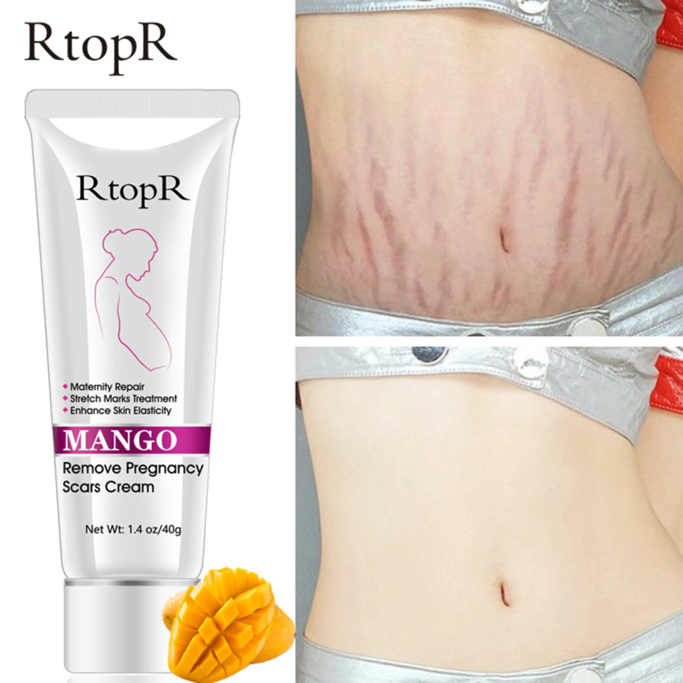 rtopr stretch mark cream