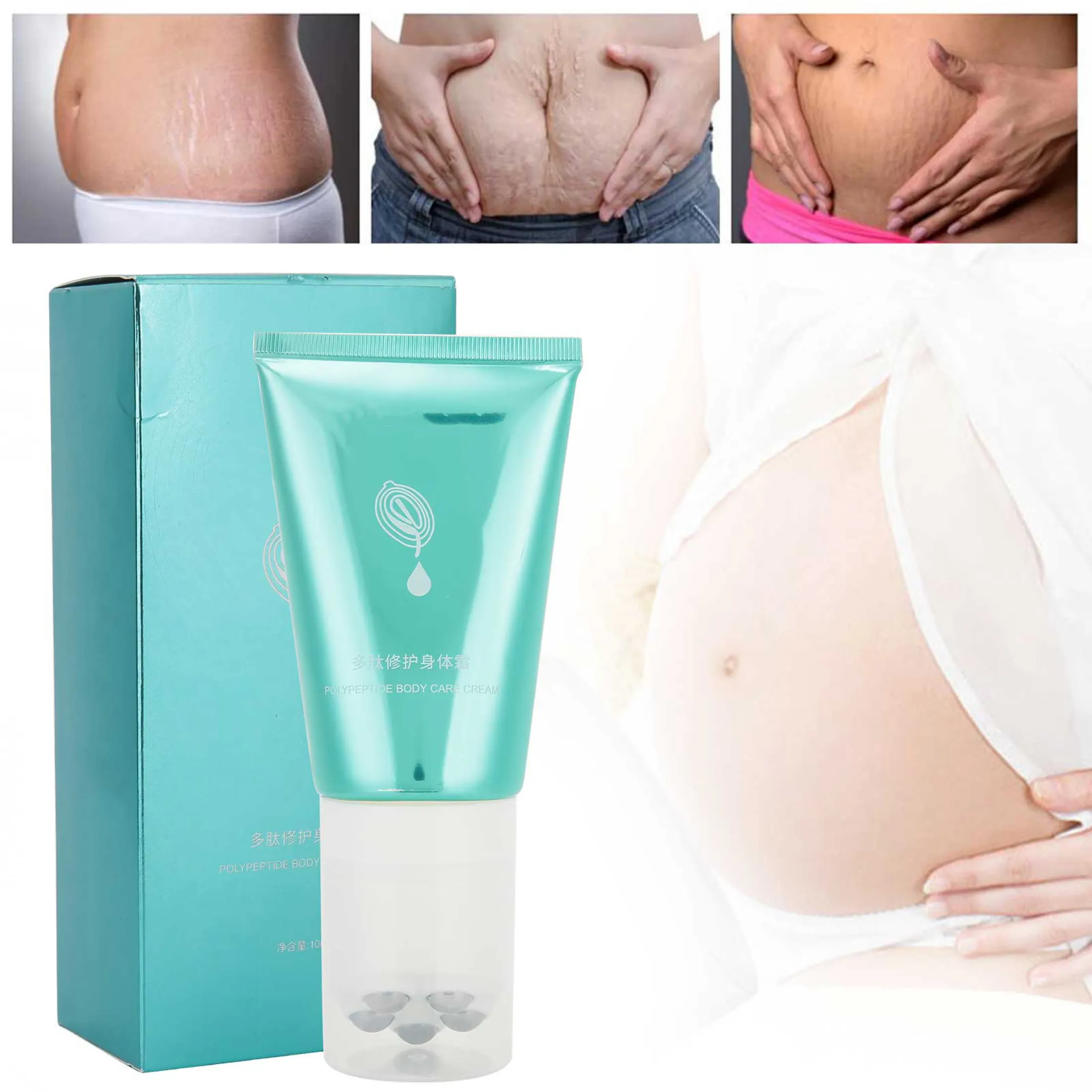 postpartum stretch mark removal