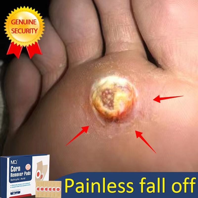 Gambar Feet Corns   Corn Remover Warts Remover Corn Callus Warts And Callus Remover Callus Removal Corn Wart Corn Remover Corn And Wart Remover Wart Remover Pad ??? batang jagung 24PCS