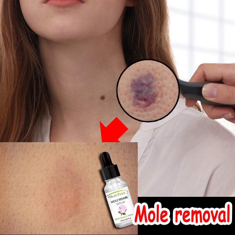 Gambar Facial nevus removing serum Painless Wart Tag Removal Liquid Tags Solutions Serum Mole Skin Dark Spot Remover Serum Freckle Skin Tag Remover