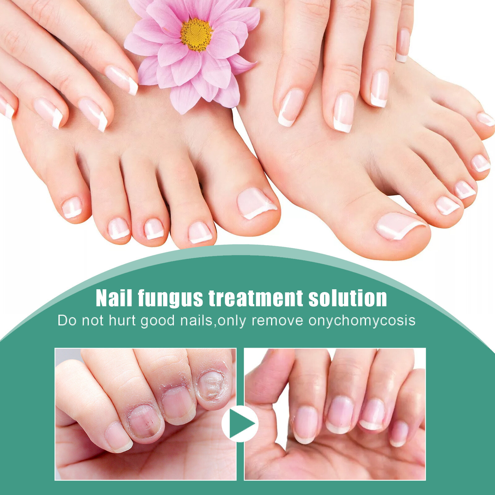 Sl Chang Nail Fungal Treatment Serum Hand Feet Care Anti Infection