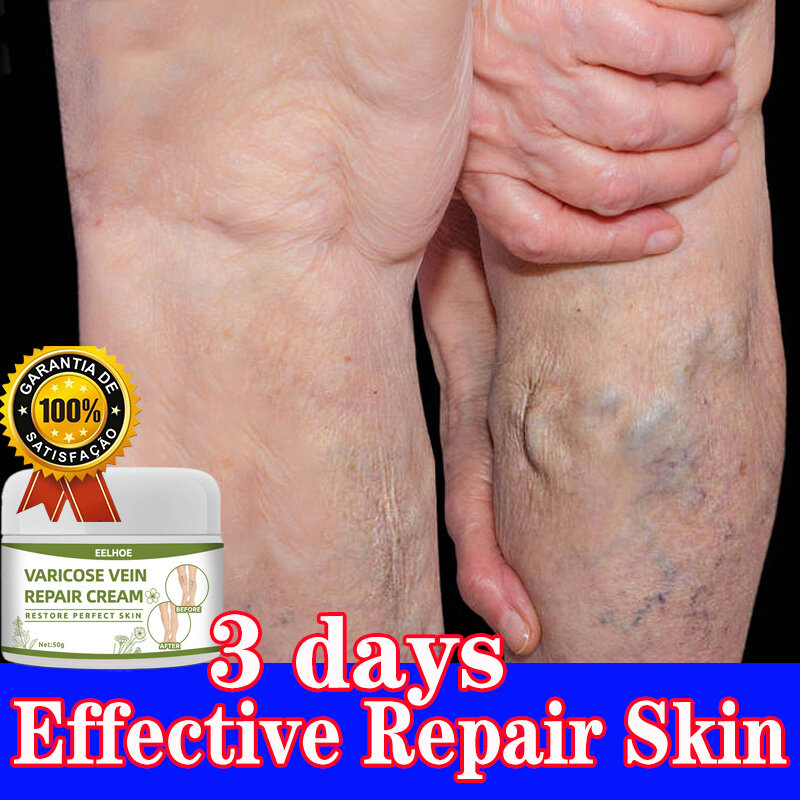 Gambar Varicose Vein Cream Effective Varicose Veins Treatment Cream  repair skin care Anti Varicose Veins Ointment 50g Effective Original Varicose Veins  Soothing Leg Cream Eliminate varicose veins   Spider Veins cream
