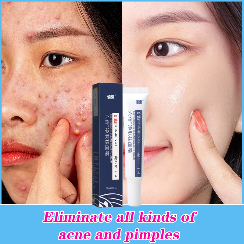Gambar Acne Pimple Gel Fades acne marks pustular cysts skin care swelling anti inflammatory mild and non irritating acne regeneration oil control pore shrinkage students men and women moisturizing and moisturizing