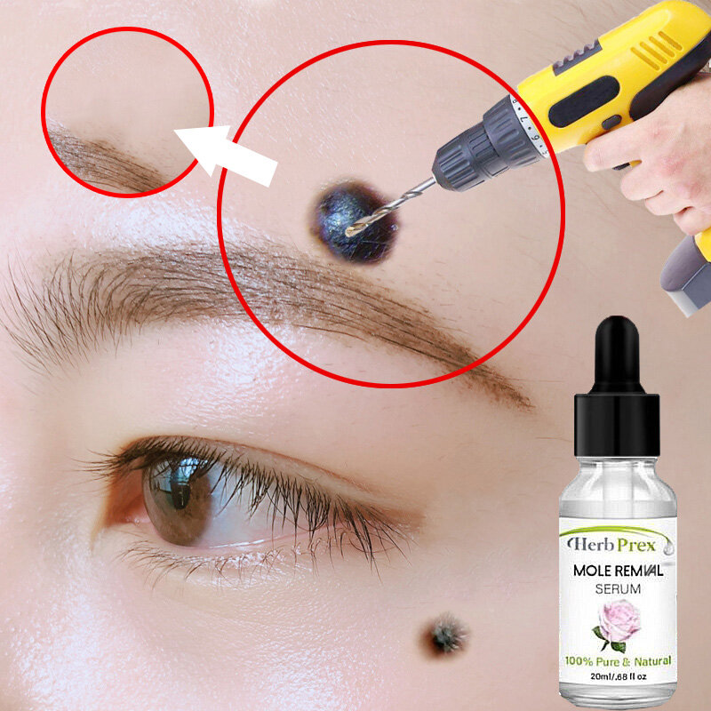 Gambar Skin Tag Remover kutil removal Mole Remover tahi lalat remover wart removal remove Ketuat Moles Freckle Melanin Spots Helps remove cream warts warts cholesterol seeds warts milia removal removal of excess skin available for men and women